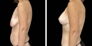before and after mommy makeover female patient left side view case 1843