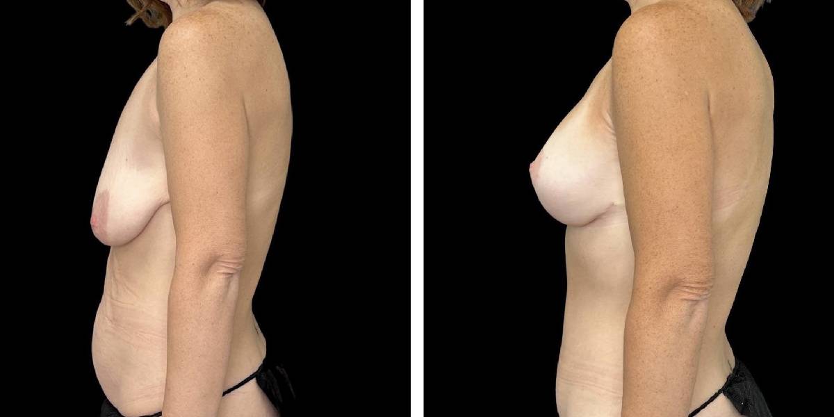 before and after mommy makeover female patient left side view case 1843