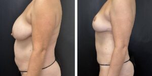 before and after mommy makeover female patient left side view case 1850