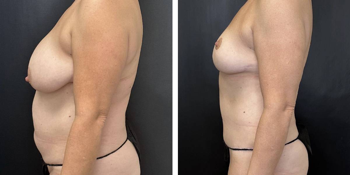 before and after mommy makeover female patient left side view case 1850