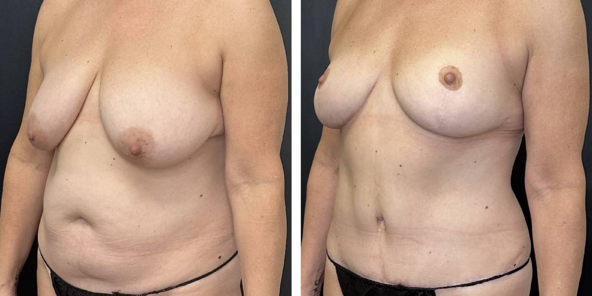 before and after mommy makeover female patient left angled view case 1850
