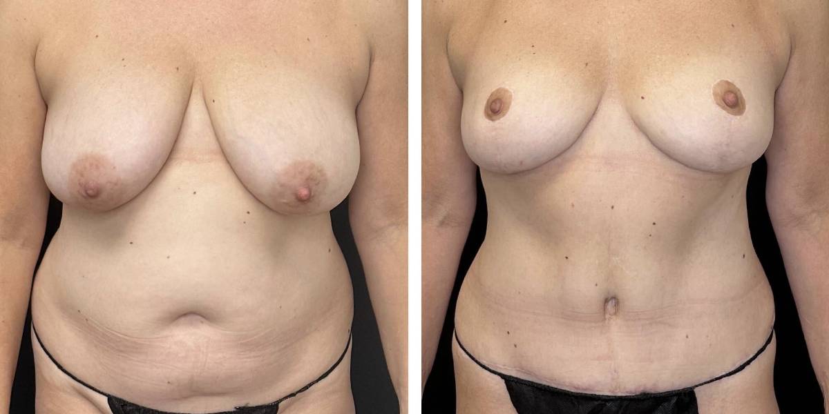 before and after mommy makeover female patient front view case 1850