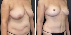 before and after mommy makeover female patient right angled view case 1850