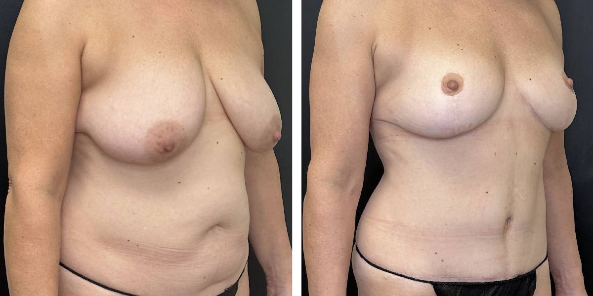 before and after mommy makeover female patient right angled view case 1850