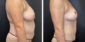 before and after mommy makeover female patient right side view case 1850