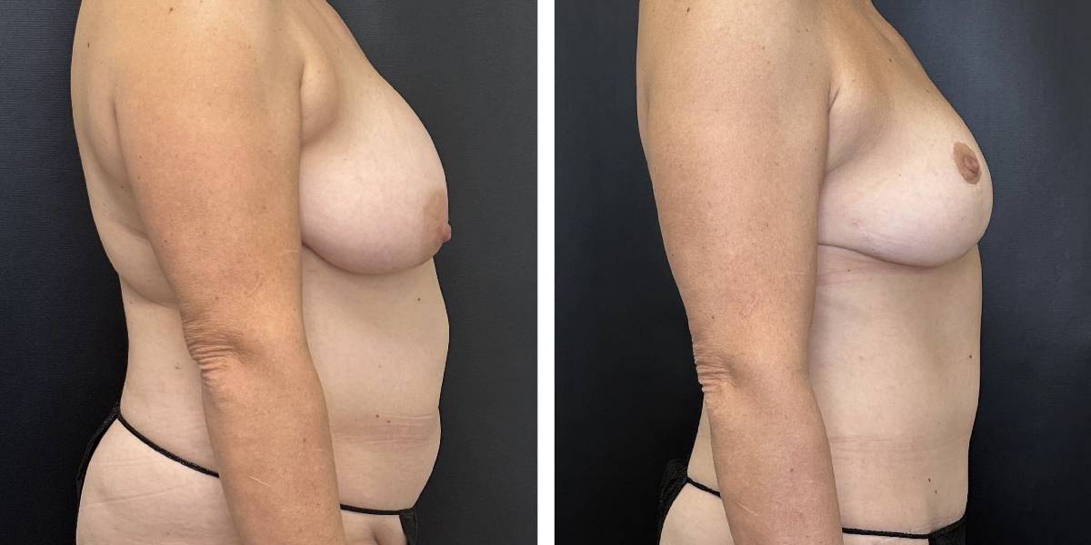 before and after mommy makeover female patient right side view case 1850