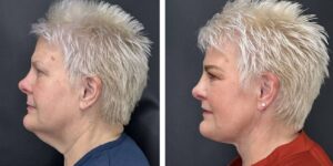 before and after MyEllevate female patient left side view case 1724