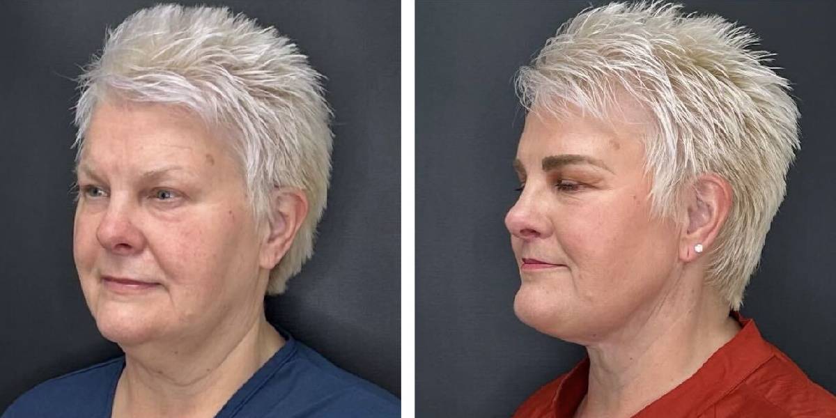 before and after MyEllevate female patient left angle view case 1724
