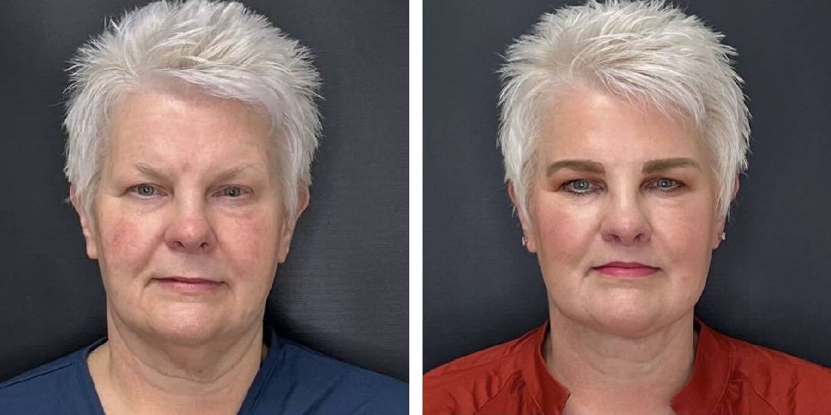 before and after MyEllevate female patient front view case 1724