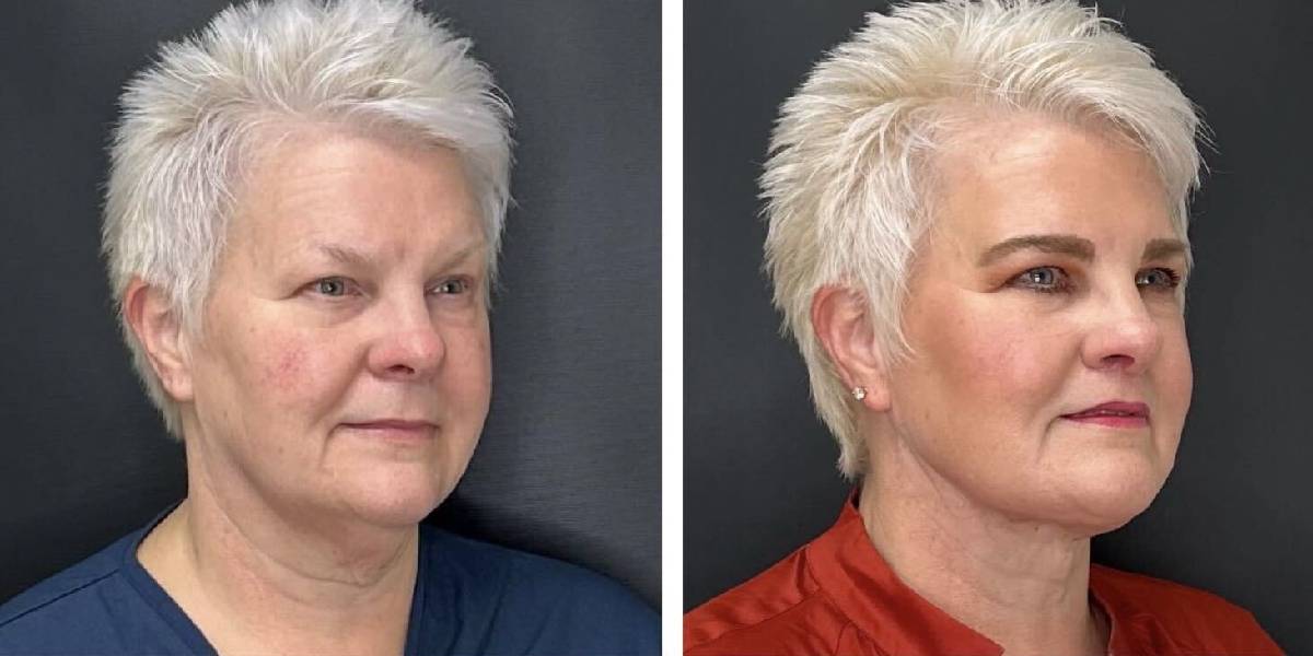 before and after MyEllevate female patient right angle view case 1724