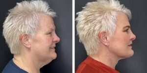 before and after MyEllevate female patient right side view case 1724