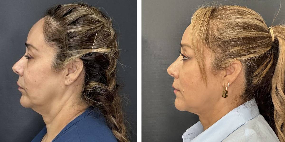 before and after facial liposuction female patient left side view case 1735