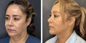 before and after facial liposuction female patient left angle view case 1735