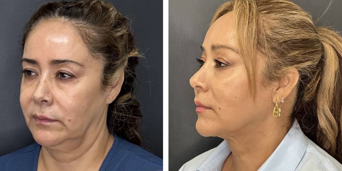 before and after facial liposuction female patient left angle view case 1735
