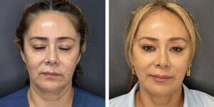 before and after facial liposuction female patient front view case 1735