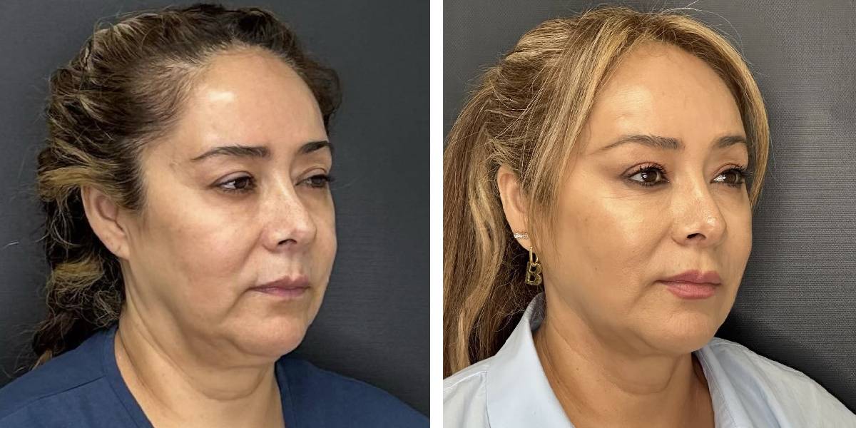 before and after facial liposuction female patient right angle view case 1735