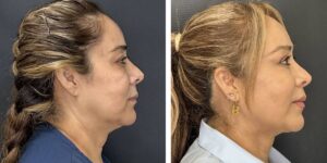 before and after facial liposuction female patient right side view case 1735