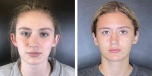 before and after otoplasty front view female patient case 1707