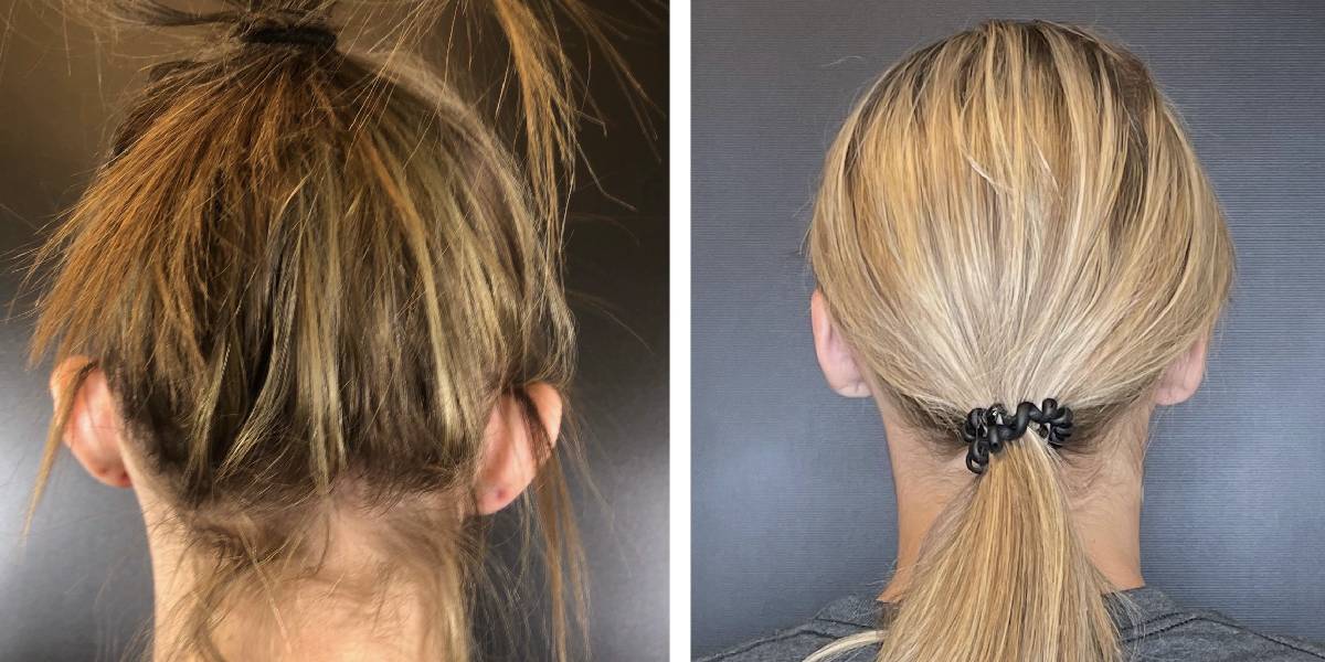 before and after otoplasty back view female patient case 1707