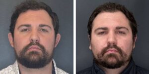 before and after otoplasty front view male patient case 1714