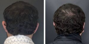before and after otoplasty back view male patient case 1714
