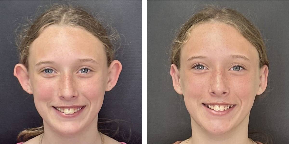 before and after otoplasty front view female patient case 1718