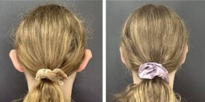 before and after otoplasty back view female patient case 1718