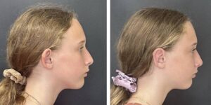 before and after otoplasty right side view female patient case 1718