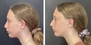 before and after otoplasty left side view female patient case 1718