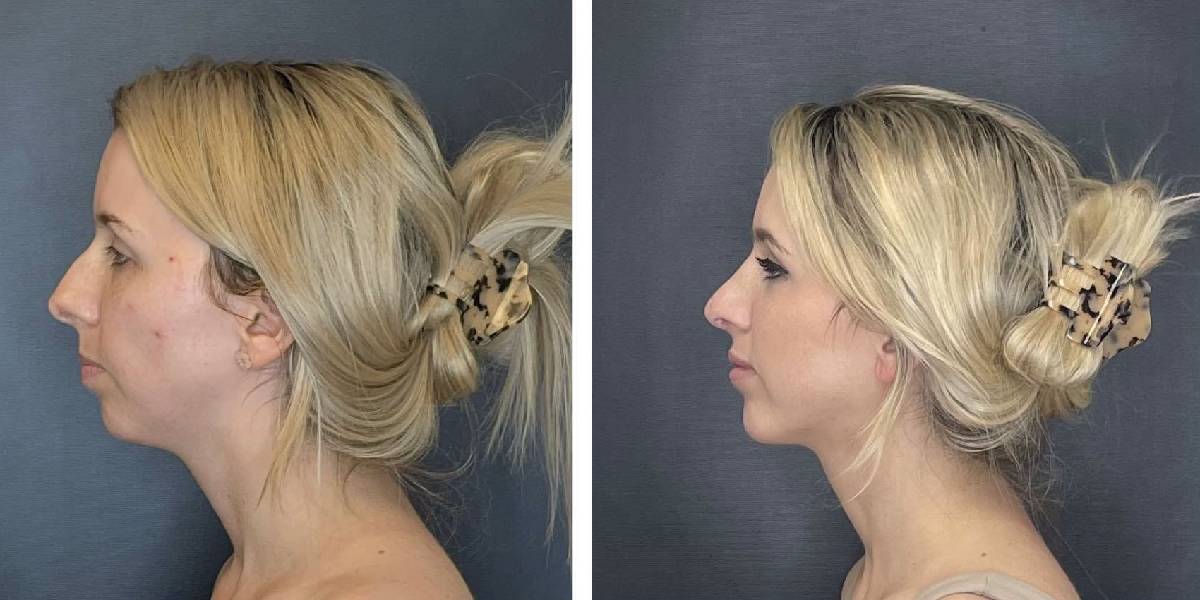 before and after rhinoplasty and chin implant left side view female patient case 1646