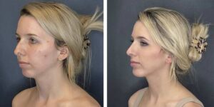 before and after rhinoplasty and chin implant left angle view female patient case 1646