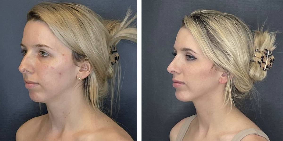 before and after rhinoplasty and chin implant left angle view female patient case 1646
