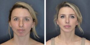before and after rhinoplasty and chin implant front view female patient case 1646