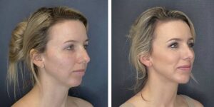 before and after rhinoplasty and chin implant right angle view female patient case 1646