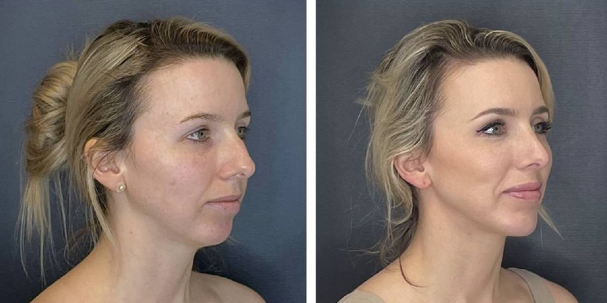 before and after rhinoplasty and chin implant right angle view female patient case 1646
