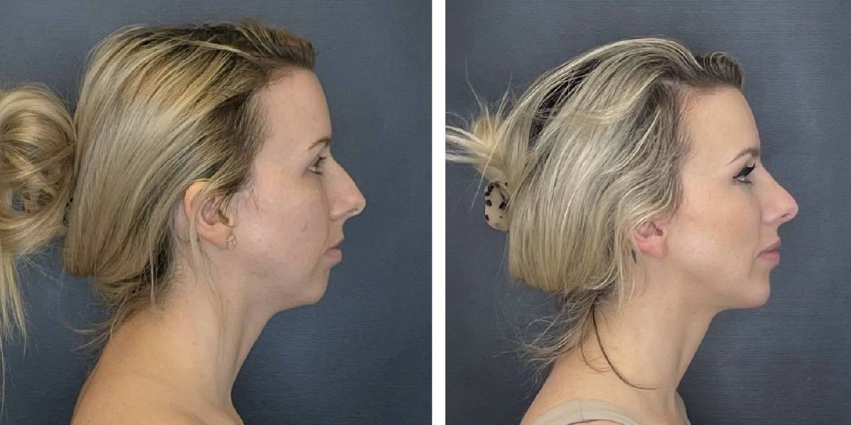 before and after rhinoplasty and chin implant right side view female patient case 1646