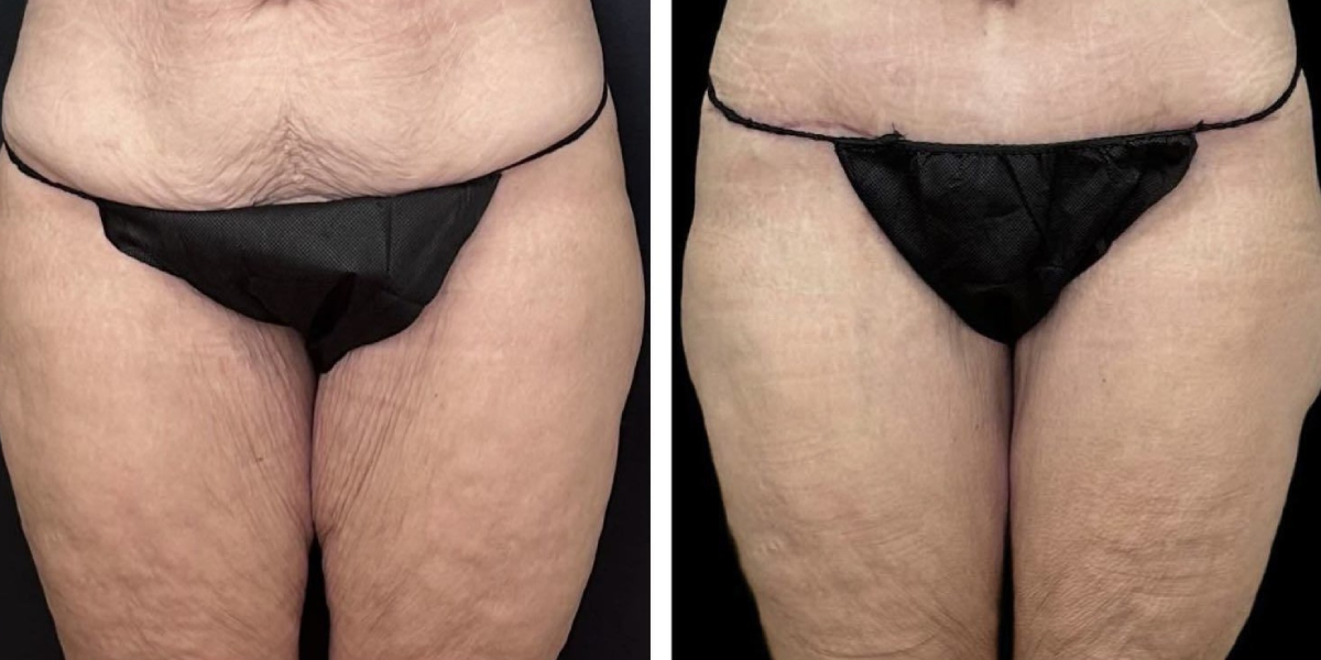 before and after thigh lift female patient front view case 1731