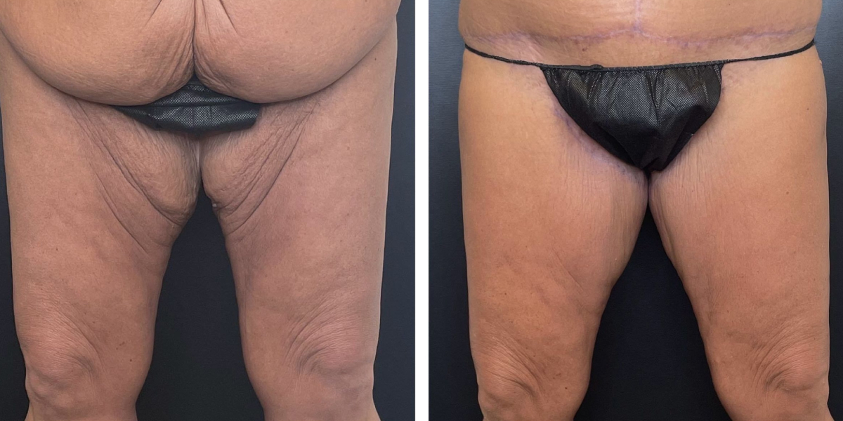 before and after thigh lift front view case 1733