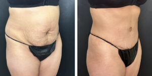 before and after tummy tuck right angled view female patient case 996