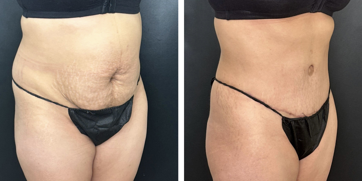 before and after tummy tuck right angled view female patient case 996