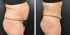 before and after tummy tuck right side view female patient case 996