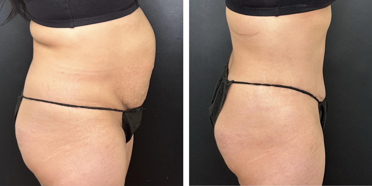 before and after tummy tuck right side view female patient case 996