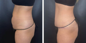before and after tummy tuck left side view female patient case 1002