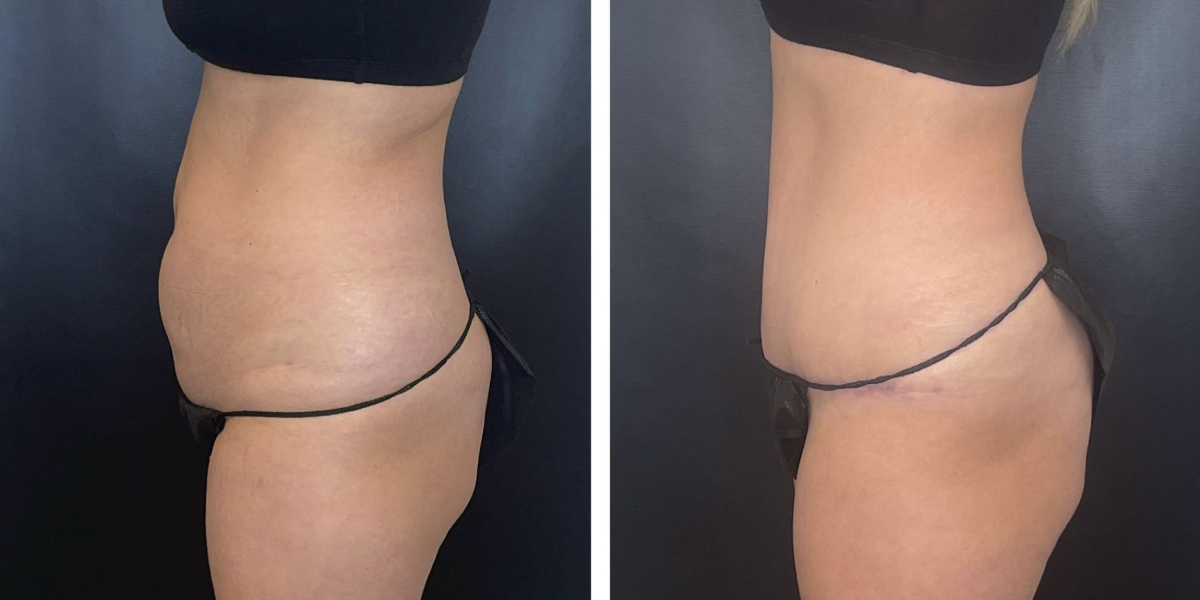before and after tummy tuck left side view female patient case 1002