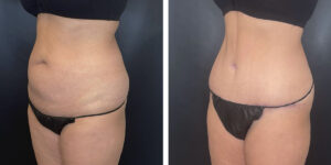 before and after tummy tuck left angled view female patient case 1002