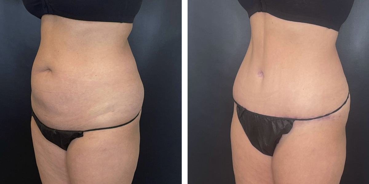 before and after tummy tuck left angled view female patient case 1002