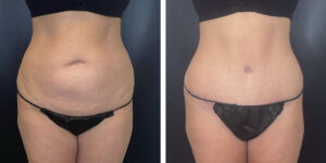 before and after tummy tuck front view female patient case 1002