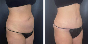before and after tummy tuck right angled view female patient case 1002