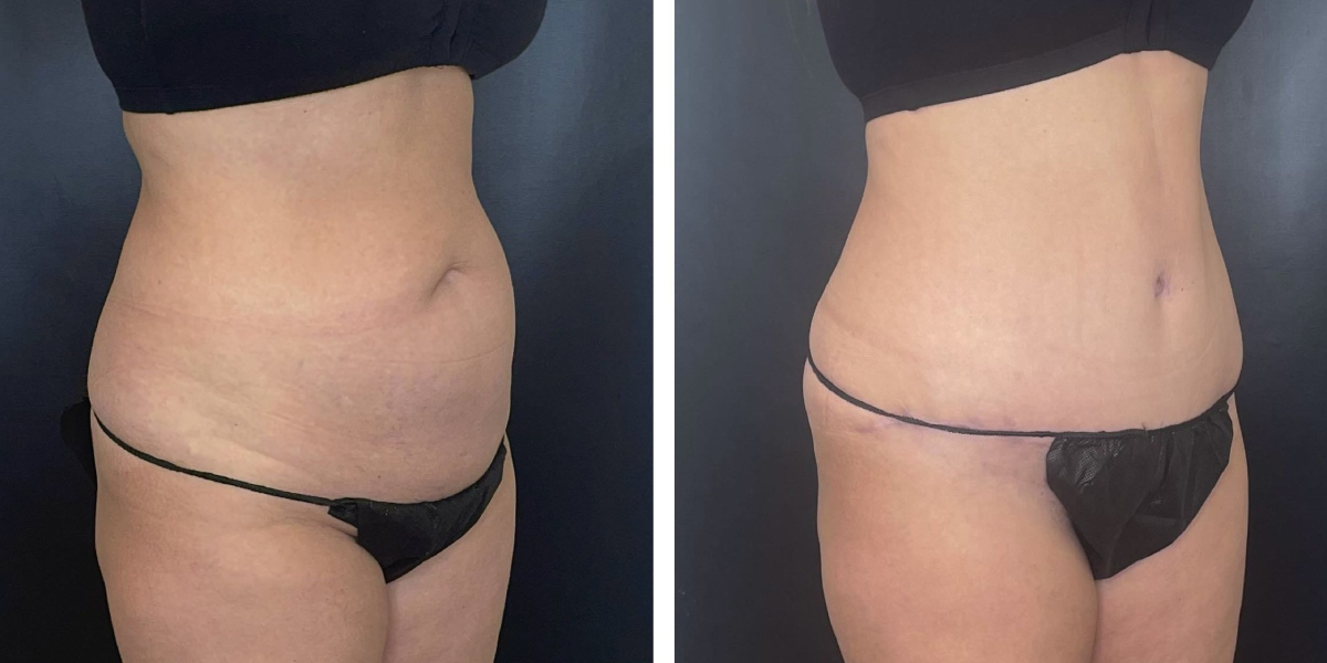 before and after tummy tuck right angled view female patient case 1002