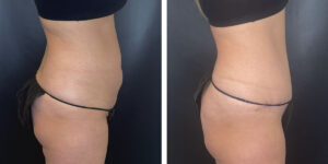 before and after tummy tuck right side view female patient case 1002